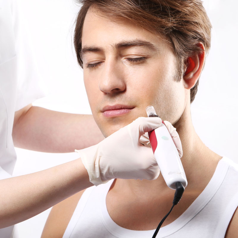 Tratamiento facial para el hombre | Microneedeling