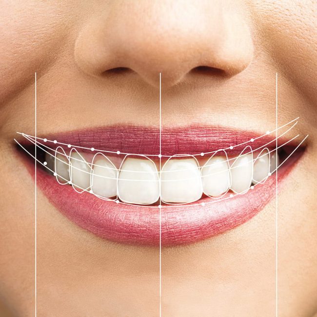 Carillas dentales | diseño de sonrisas