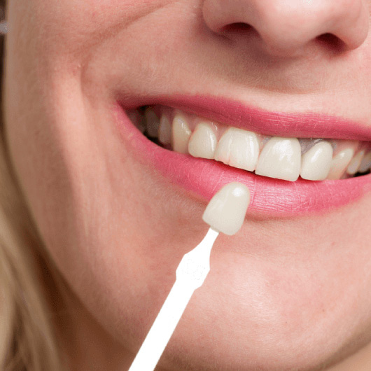 Carillas dentales para mujeres y diseño de sonrisas