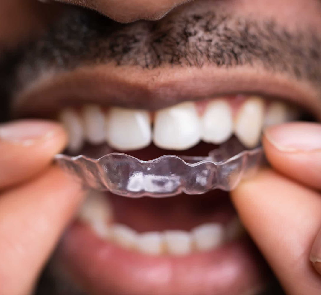 Ortodoncia invisalign para hombres